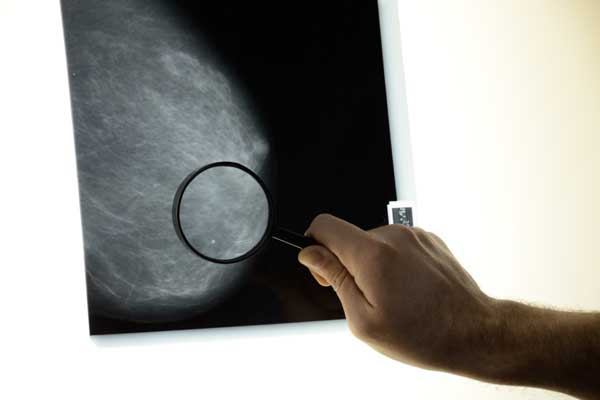 Mamografija u Bolnici Sveti Nikola