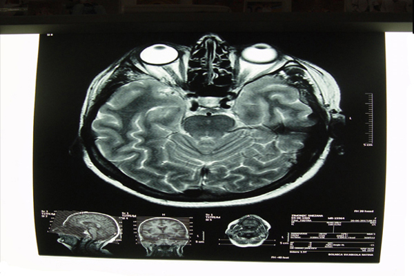 Neurohirurgija u Bolnici Sveti Nikola